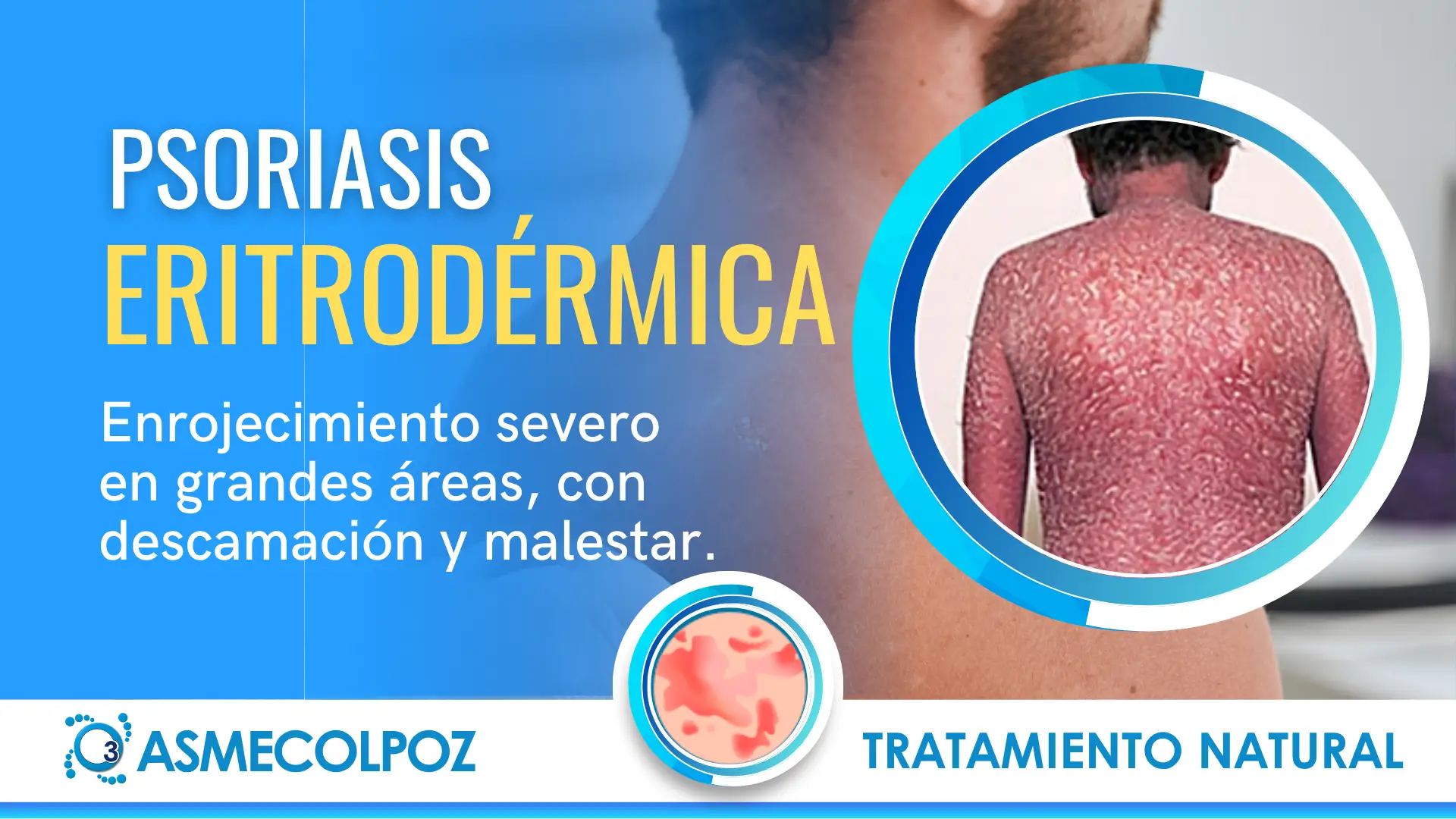 TRATAMIENTO PSORIASIS
