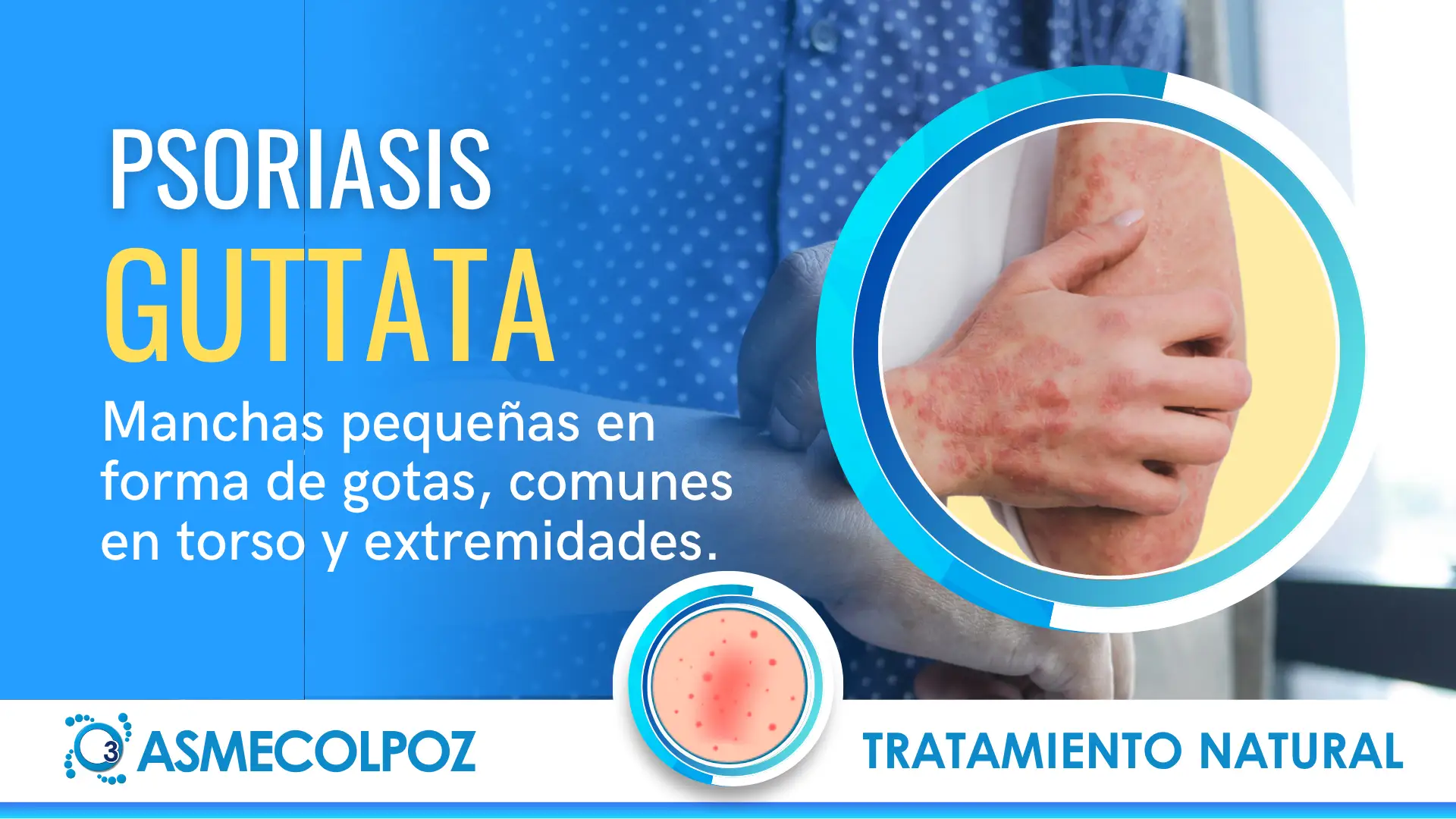 TRATAMIENTO PSORIASIS GUTTATA