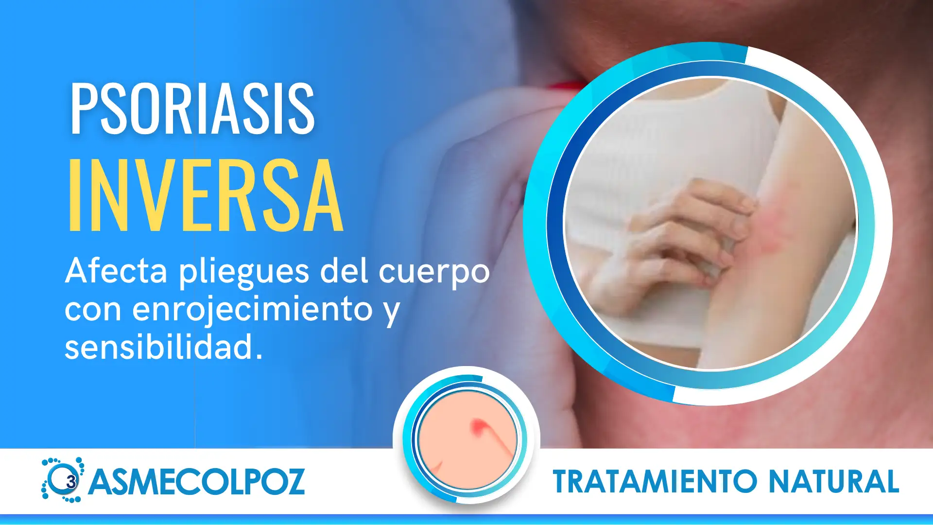 TRATAMIENTO PSORIASIS INVERSA